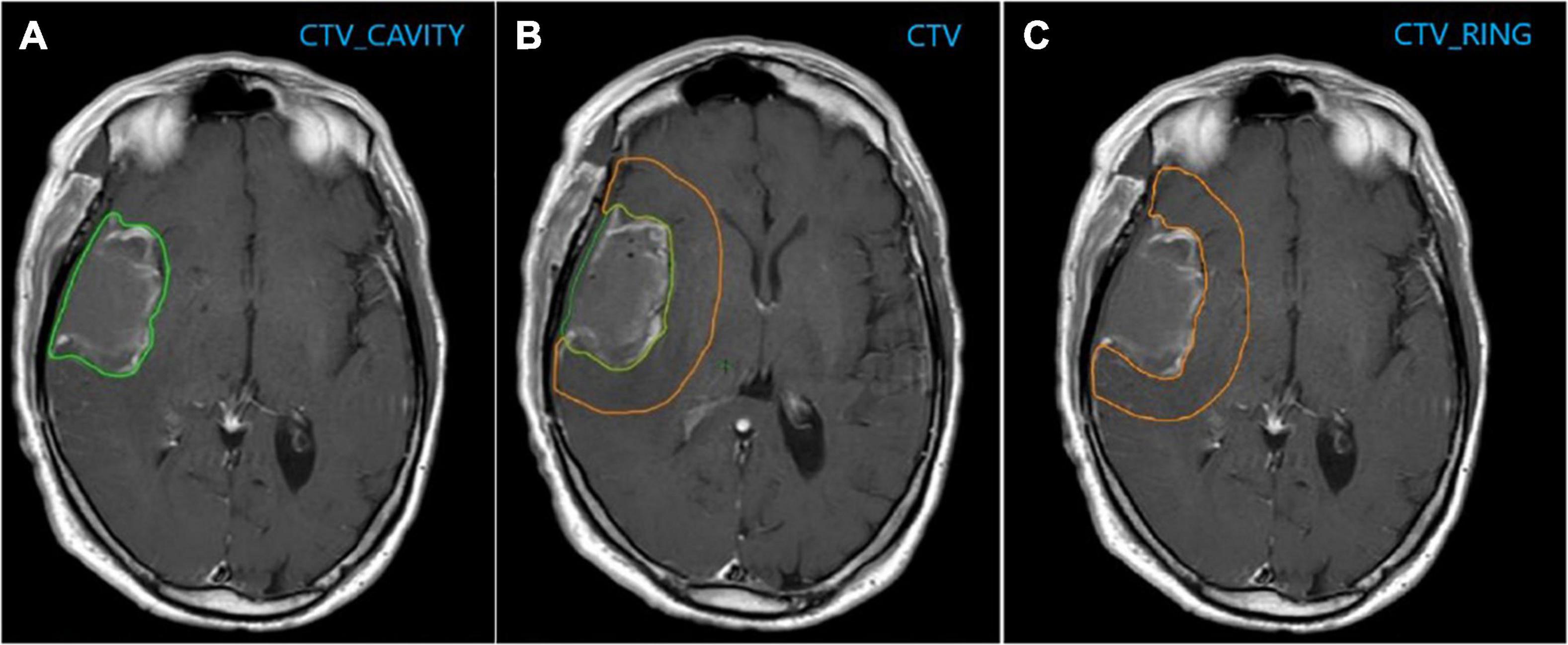 MRI-derived radiomics to guide post-operative management of glioblastoma: Implication for personalized radiation treatment volume delineation